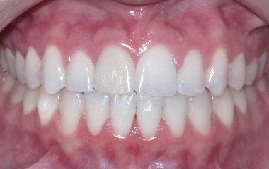 Image of Teeth after Damon braces (18 months) - Gainesville, GA | Wilson Orthodontics