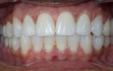 Image of Teeth after Damon braces (24 months) - Gainesville, GA | Wilson Orthodontics