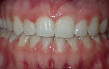 Image of Teeth after Damon braces (Surgical Case) - Gainesville, GA | Wilson Orthodontics