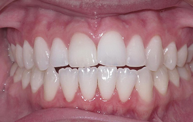 Image of Teeth before Damon braces (18 months) - Gainesville, GA | Wilson Orthodontics