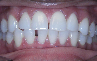 Image of Teeth before Damon braces (24 months) - Gainesville, GA | Wilson Orthodontics