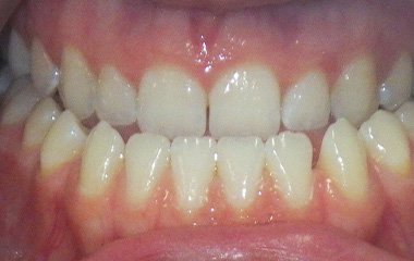 Image of Teeth before Damon braces (Surgical case) - Gainesville, GA | Wilson Orthodontics