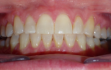 Image of Teeth after Invisalign treatment (20 months) - Gainesville, GA | Wilson Orthodontics