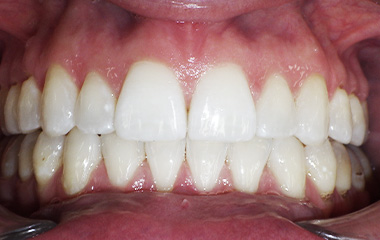 Wilson Orthodontics Invisalign After