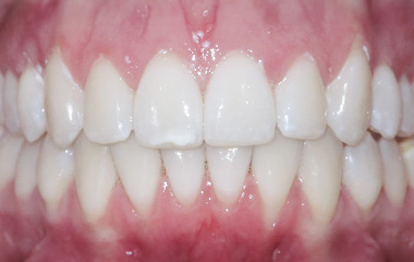 Image of Teeth after Invisalign treatment (24 months) - Gainesville, GA | Wilson Orthodontics