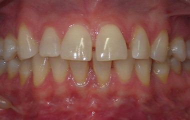 Image of Teeth before Invisalign treatment (20 months) - Gainesville, GA | Wilson Orthodontics