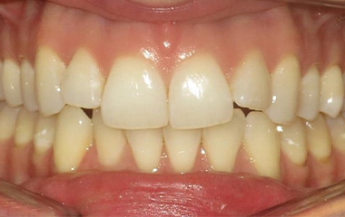 Wilson Orthodontics Invisalign Results Before