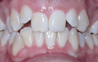 Image of Teeth before Invisalign treatment (24 months) - Gainesville, GA | Wilson Orthodontics